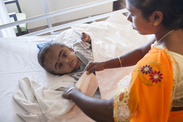 印巨頭女嬰術(shù)后頭圍縮小恢復良好