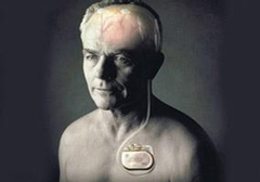 起搏器真的能治好帕金森病嗎？